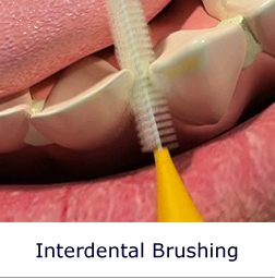 Interdental Brushing